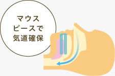 マウスピースで気道確保