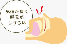 気道が狭く呼吸がしづらい